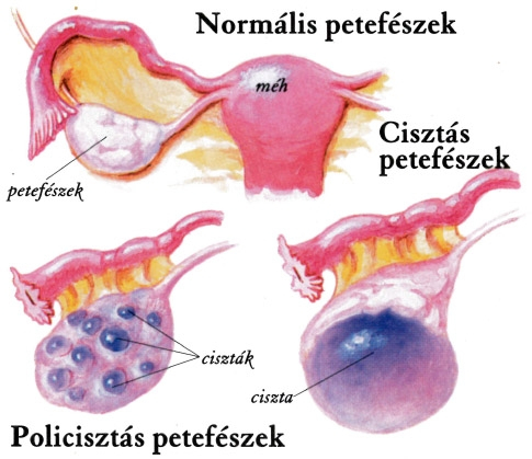 rosszindulatú ciszta)