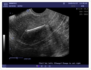 Mirena/Jaydess/Levosert levonorgestrel - intrauterin rendszer