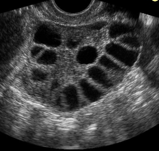 petefészekrák látható ultrahangon hogyan kell kezelni a férgeket a tüdőben
